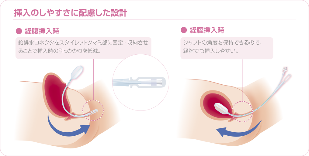 ナガタさんちの子育て奮闘記～育児マンガ～ 「何人産んでも出産は痛い〜バルーンと促進剤〜」│BABYDOT ベイビードット