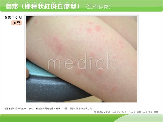薬疹、多形紅斑皮膚科広島市立北部医療センター安佐市民病院