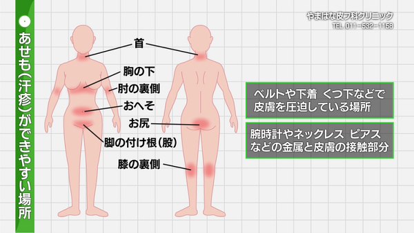 あせも 汗疹 に効く処方薬と病院での治療同じ成分の市販薬も解説ミナカラ minacolor