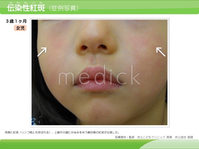 伝染性紅斑 リンゴ病 、コクサッキー・アデノ・RSウイルスと甲状腺 長崎甲状腺クリニック 大阪