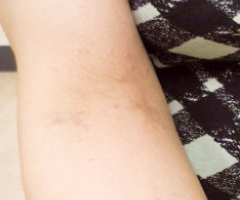 ストレスによる皮膚炎・湿疹の特徴は？アトピー悪化との関係や治し方を解説ふくろうの森クリニック 公式