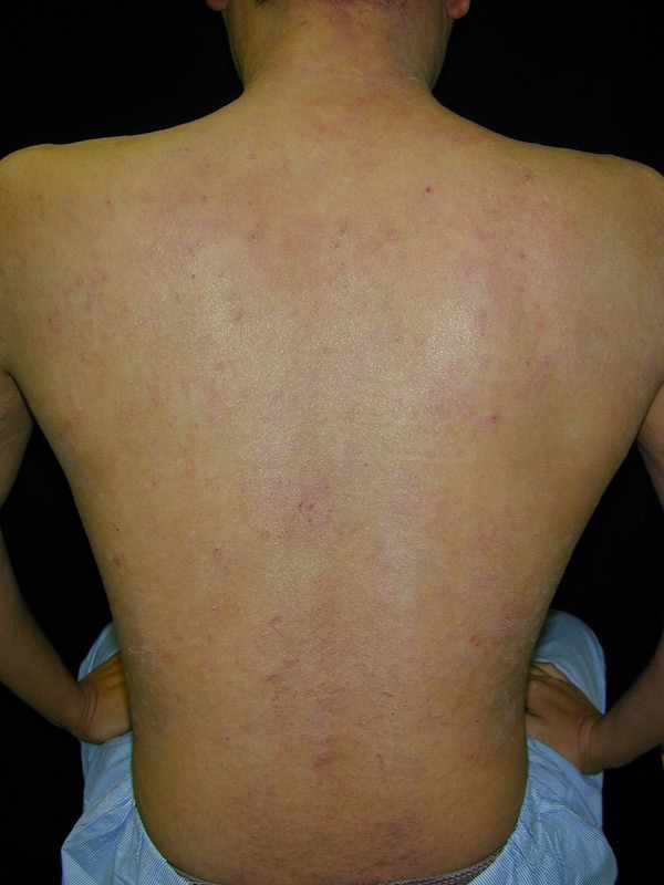 女性のアトピー性皮膚炎に特有な背中の肌荒れの改善例！美保薬局福島県いわき市の皮膚病お悩み相談専門の経験豊富な薬局です