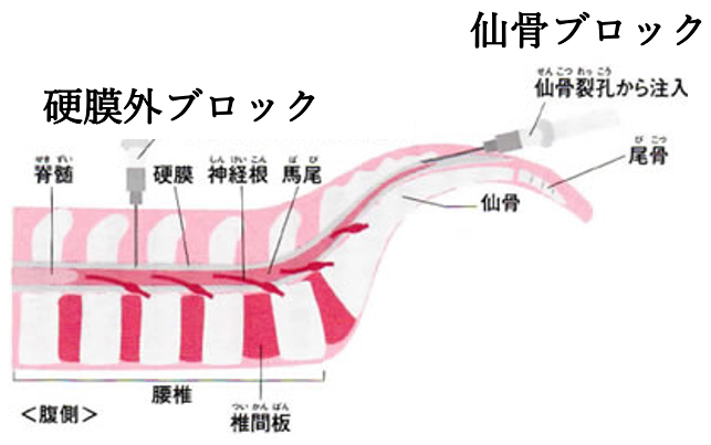 仙骨裂孔 - e-Anatomy - IMAIOS