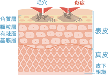 ニキビの位置で体の不調がわかる」と図が拡散。専門医「全くの都市伝説」
