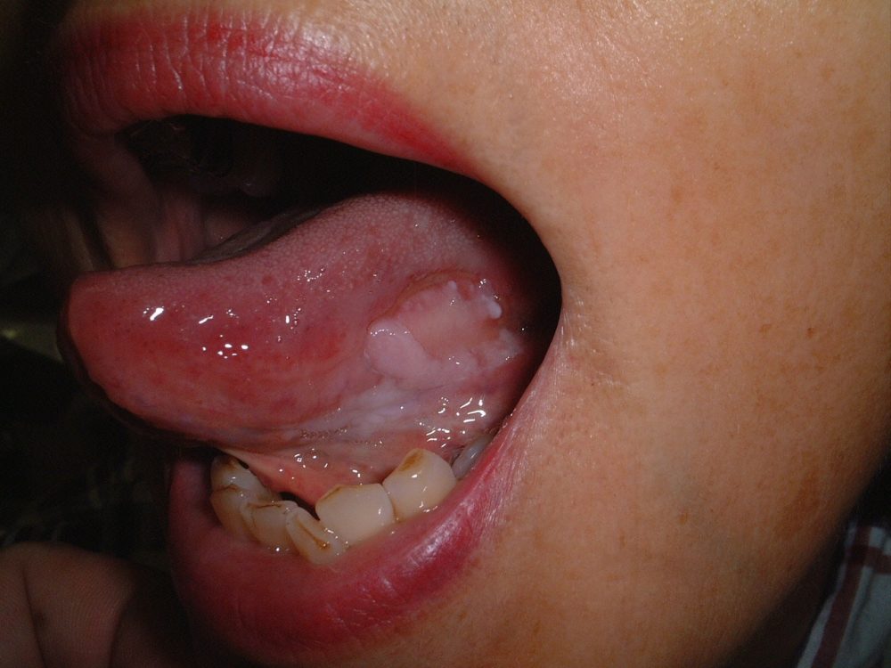 舌の口内炎と舌癌はどう違うのか口腔外科医のお役立ちコラム 東京銀座シンタニ歯科口腔外科クリニック