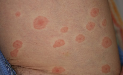 原発疹とは続発疹との違い原発疹の種類 斑、丘疹、結節、膨疹、水疱など