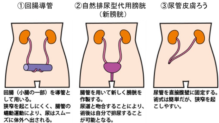 尿膜管遺残診療部門のご案内地方独立行政法人 市立吹田市民病院