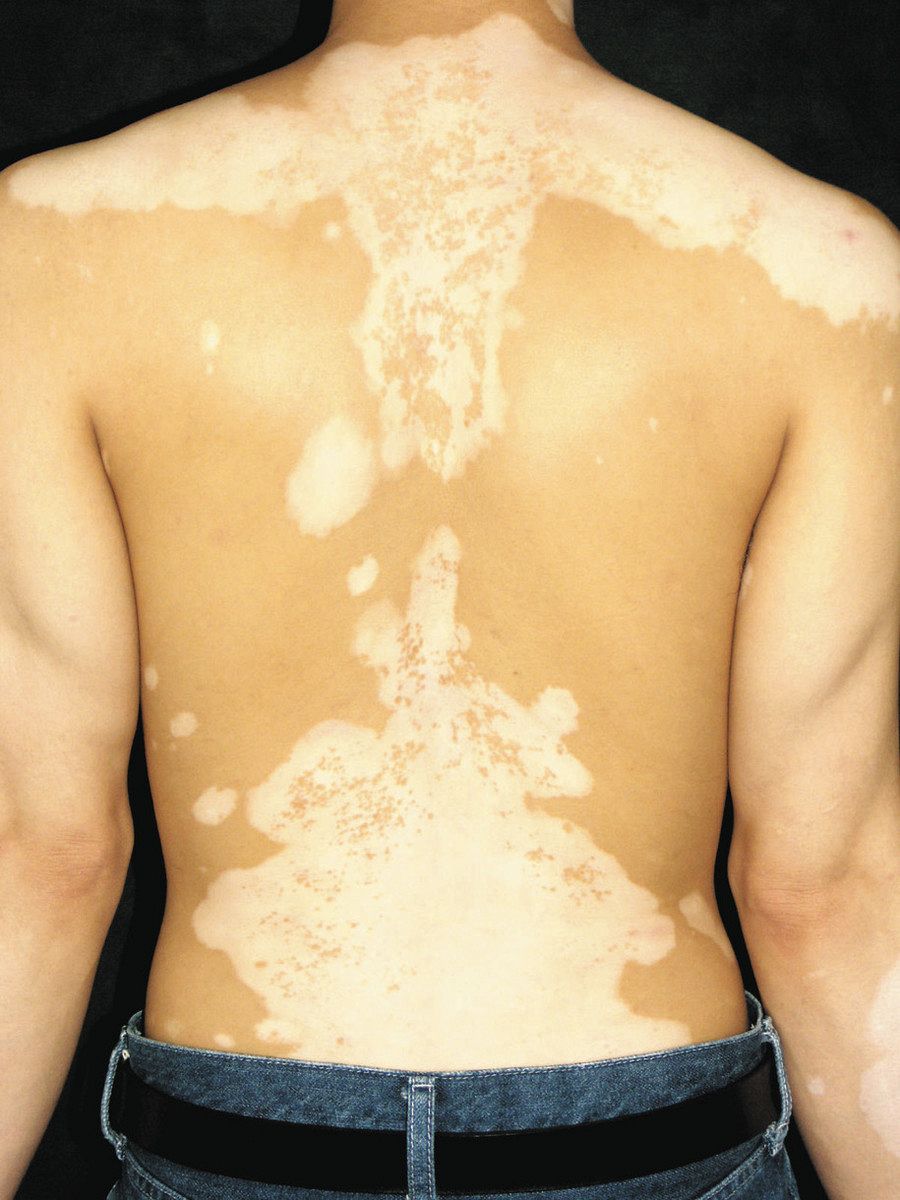 尋常性白斑 の症状と漢方について大手町薬局