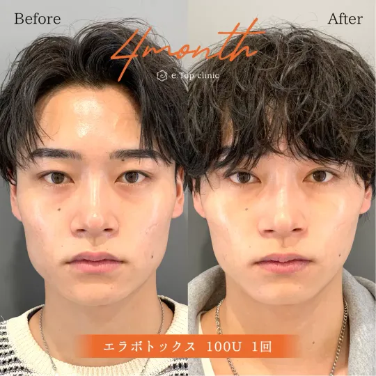 小顔ボトックス注射 エラボトックス 東京新宿の美容整形ならもとび美容外科クリニック