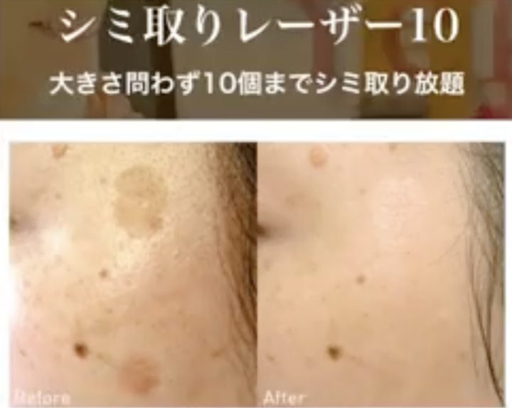 シミ取りレーザー経過ダウンタイムやケア方法について詳しく解説