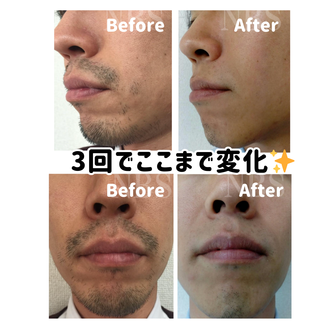 ヒゲ脱毛で後悔しない方法おすすめのサロン・クリニックも解説マルイのネット通販 マルイウェブチャネル