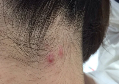 皮膚良性腫瘍 おでき医療法人社団 美啓会 ぎふスキンケアクリニック – 岐阜市の形成外科・美容外科・美容皮膚科