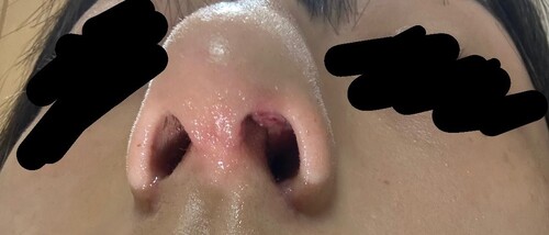 鼻の中のできものが痛い」時の対処法はご存知ですか？医師が徹底解説！ 症状の原因・病気一覧・診療科 - メディカルドック