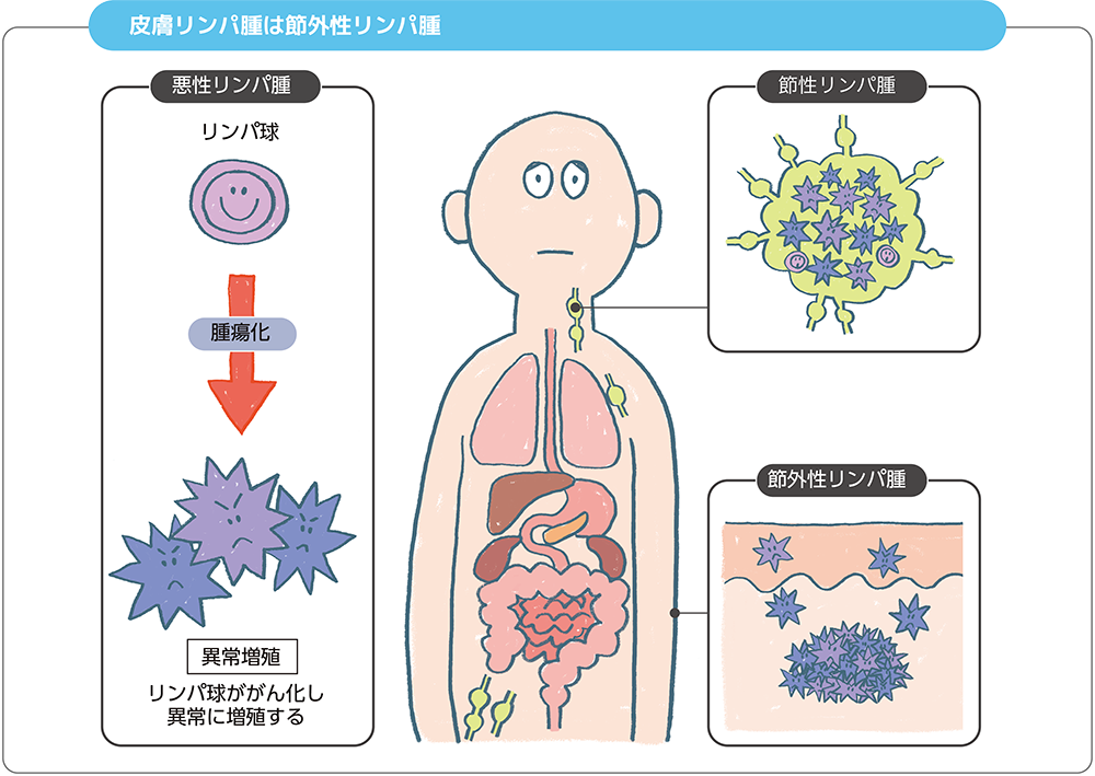 パート113 悪性リンパ腫 2共進株式会社