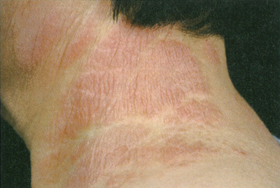 皮膚が白く抜ける！？ しろなまず『白斑』あつた皮ふ科・美容皮膚科クリニック名古屋市中川区の皮ふ科・美容皮膚科