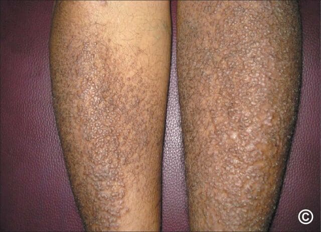 口腔扁平苔癬歯科口腔外科症例解説東京銀座シンタニ歯科口腔外科クリニック