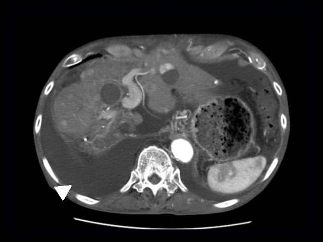 肝硬変について