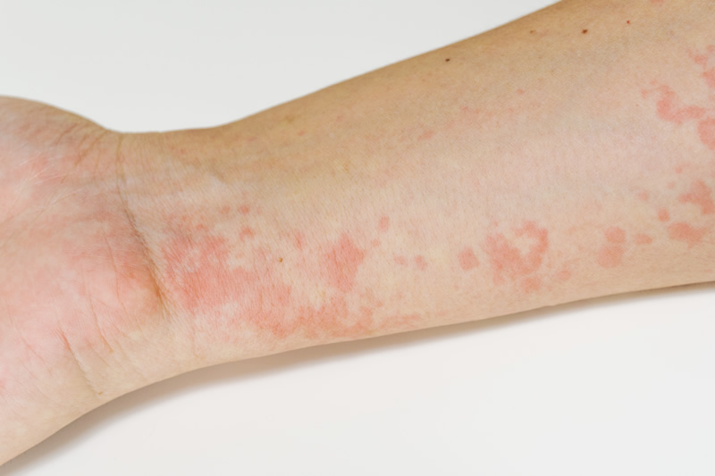 蕁麻疹 じんましん の治療は岸和田・皮膚科あぶみクリニック