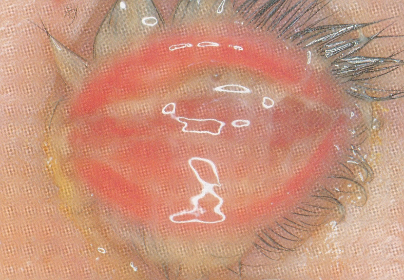 尿道口から膿が出る日本泌尿器科学会The Japanese Urological Association一般のみなさま