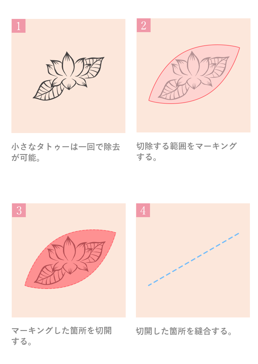 m3電子書籍PEPARS ペパーズNo.14 縫合の基本手技