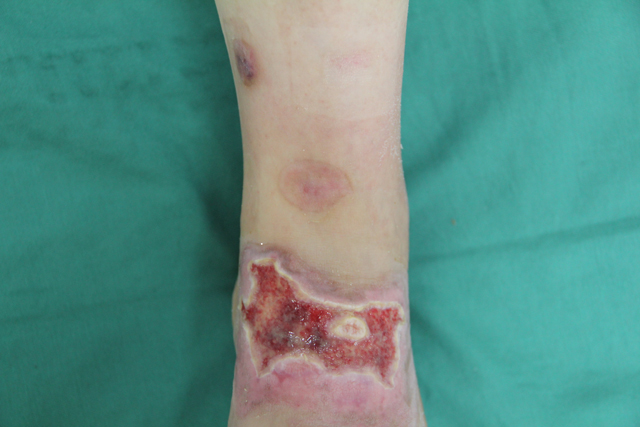 やけど 熱傷 一般社団法人 日本創傷外科学会 一般の皆様へ