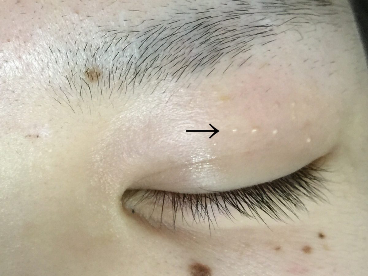 眼瞼黄色種 がんけんおうしょくしゅ診療案内共立美容外科宇都宮院 栃木県宇都宮市の美容外科・美容皮膚科 美容整形