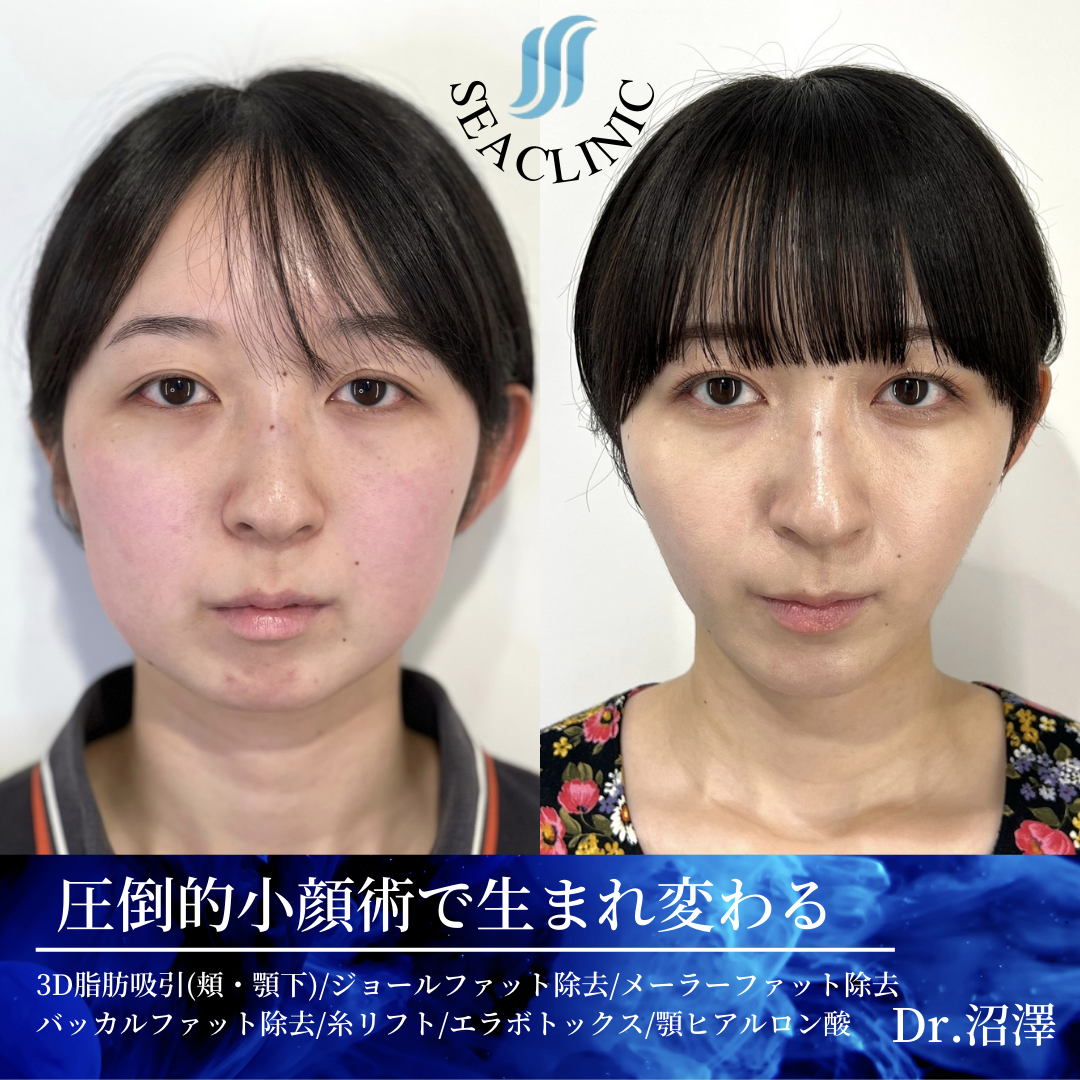 夜のぐりぐり顔筋ほぐし 頬・あご・目元のむくみ解消 - 日本経済新聞