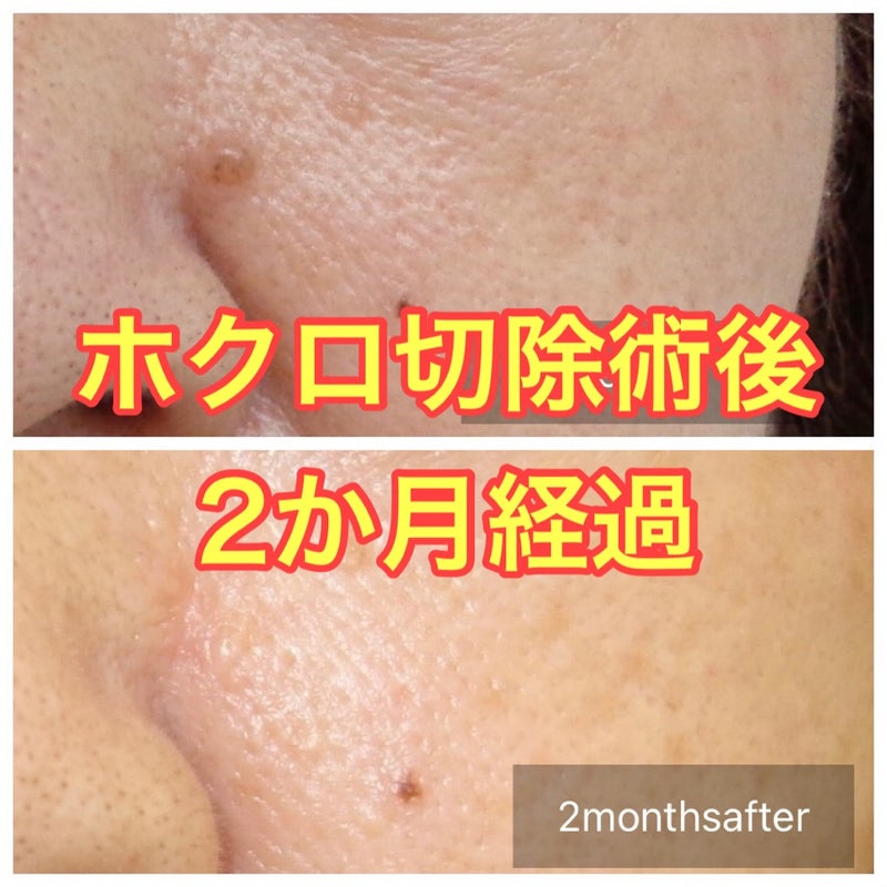 皮膚の良性腫瘍・水前寺皮フ科医院熊本市の皮膚科・形成外科・アレルギー科