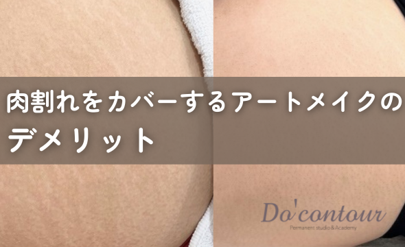 皮膚のたるみ・肉割れ・ひび割れの原因と薄くする方法