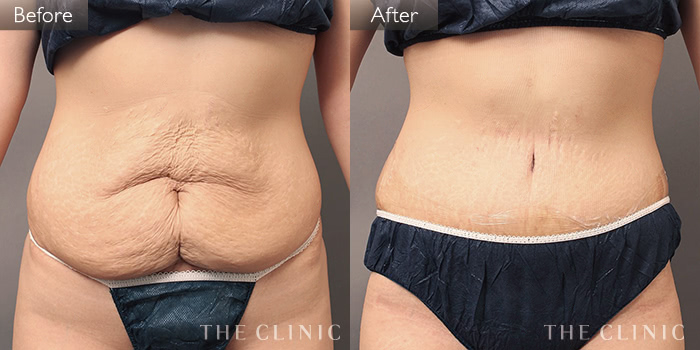 産後のお腹の皮膚のたるみが目に見えて改善！マイクロカレント＊流山の託児付き女性専門治療院 女性とこどもの保健室