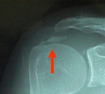 Hospitalist ~なんでも無い科医の勉強ノート~: Crowned dens syndromeとAcute calcificprevertebral tendinitis