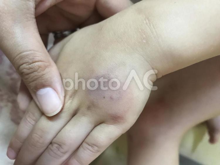 点滴のあと 内出血が少々ひどい写真です。閲覧注意。さまざま日記 ディズニークルーズ・聴神経腫瘍など闘病記・中学受験