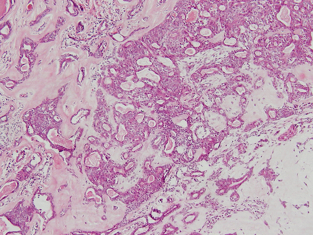 脂肪腫 lipoma のCT、MRI画像所見のポイント