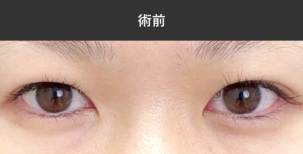 厚く腫れぼったい瞼 - タイトルの通り、私の目は厚く腫れぼっ Q&A - @cosme アットコスメ