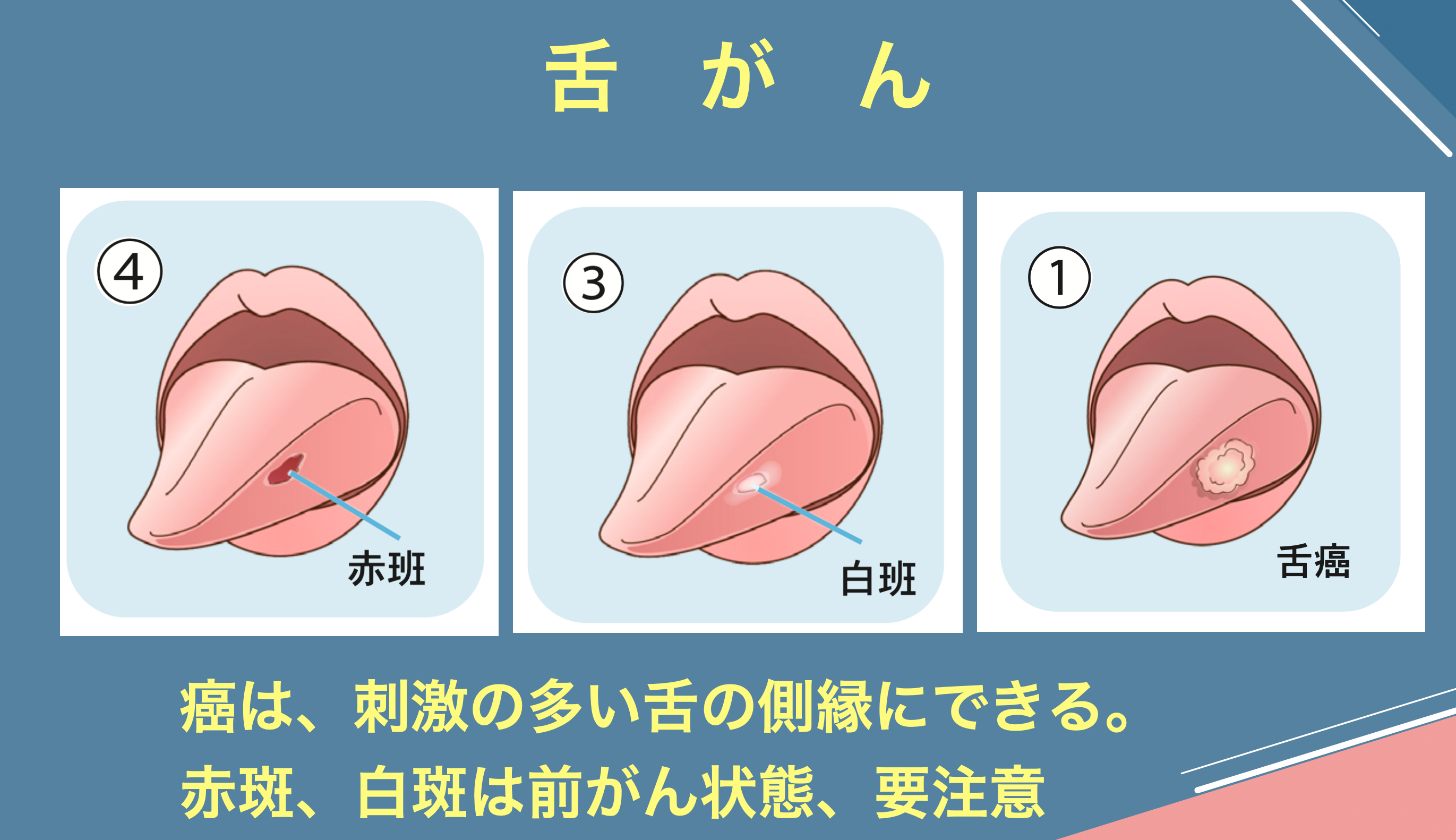舌痛症とは？疑われる症状となりやすい人、医療機関別の治療法と薬 - 東戸塚の歯医者おかざき歯科クリニック横浜市東戸塚駅のインプラント、セラミック審美歯科、矯正歯科治療の歯医者