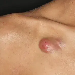 二の腕の皮膚線維腫を切除。術後1年3か月目。かなりきれいになりました。豊洲佐藤クリニック