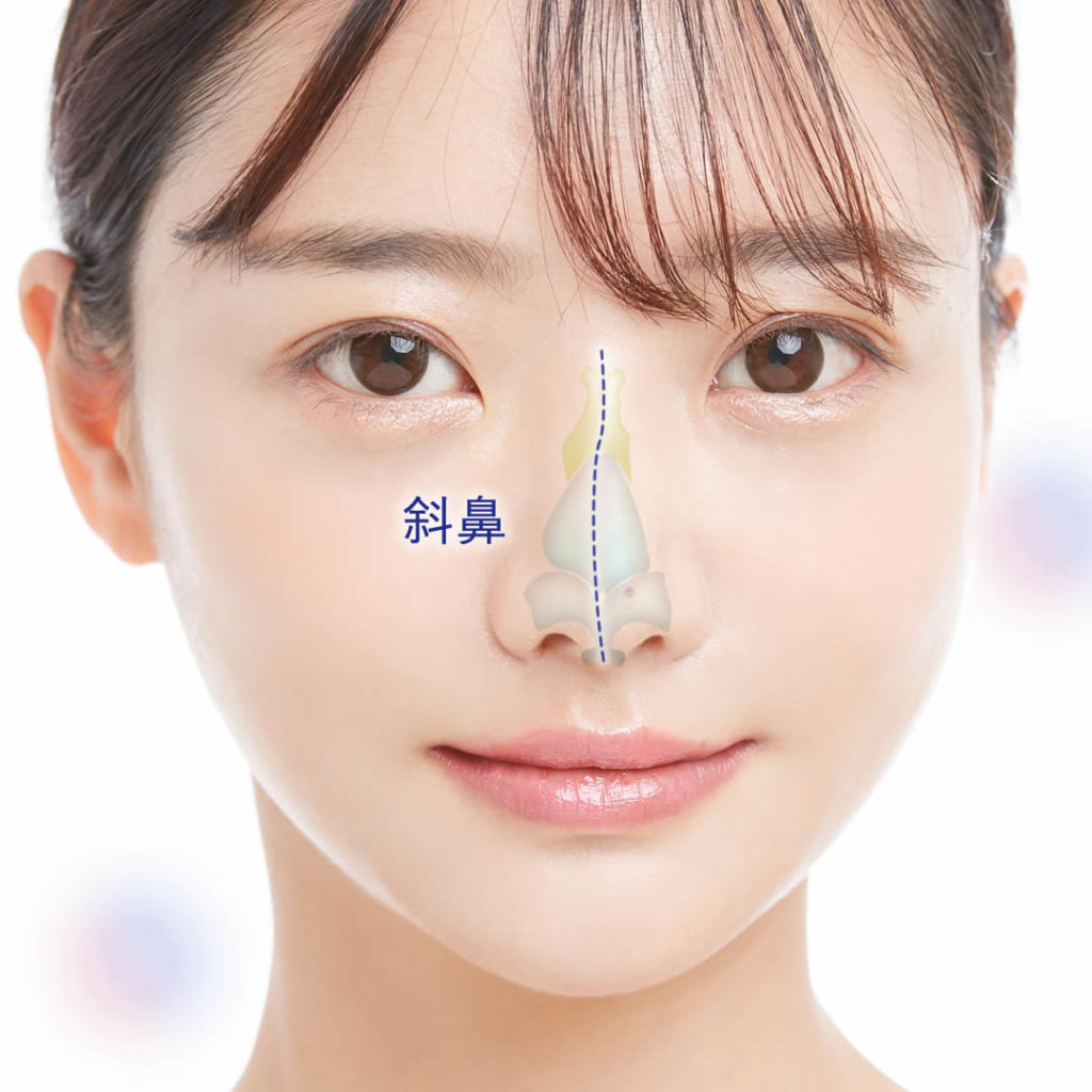 斜鼻修正術、鼻の整形なら美容外科・美容皮膚科AiZクリニック AiZクリニック アイズクリニック 美容外科・美容皮膚科
