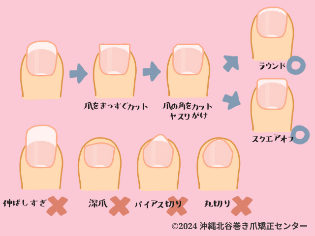 巻き爪の原因は爪切り!?正しい爪の切り方と爪切りの選び方巻き爪研究所