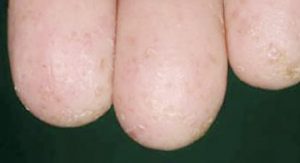 お子様の皮膚疾患についてきむら内科小児科クリニック名古屋市緑区