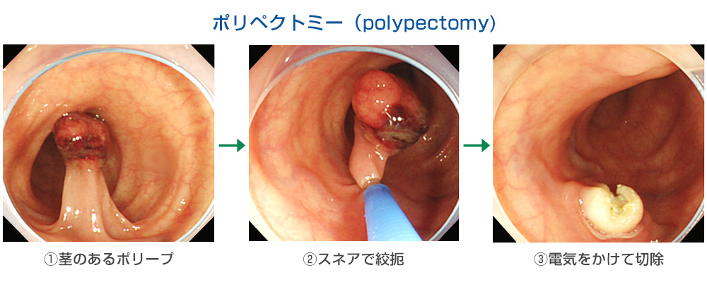 消化器センター大腸ポリープ東鷲宮病院