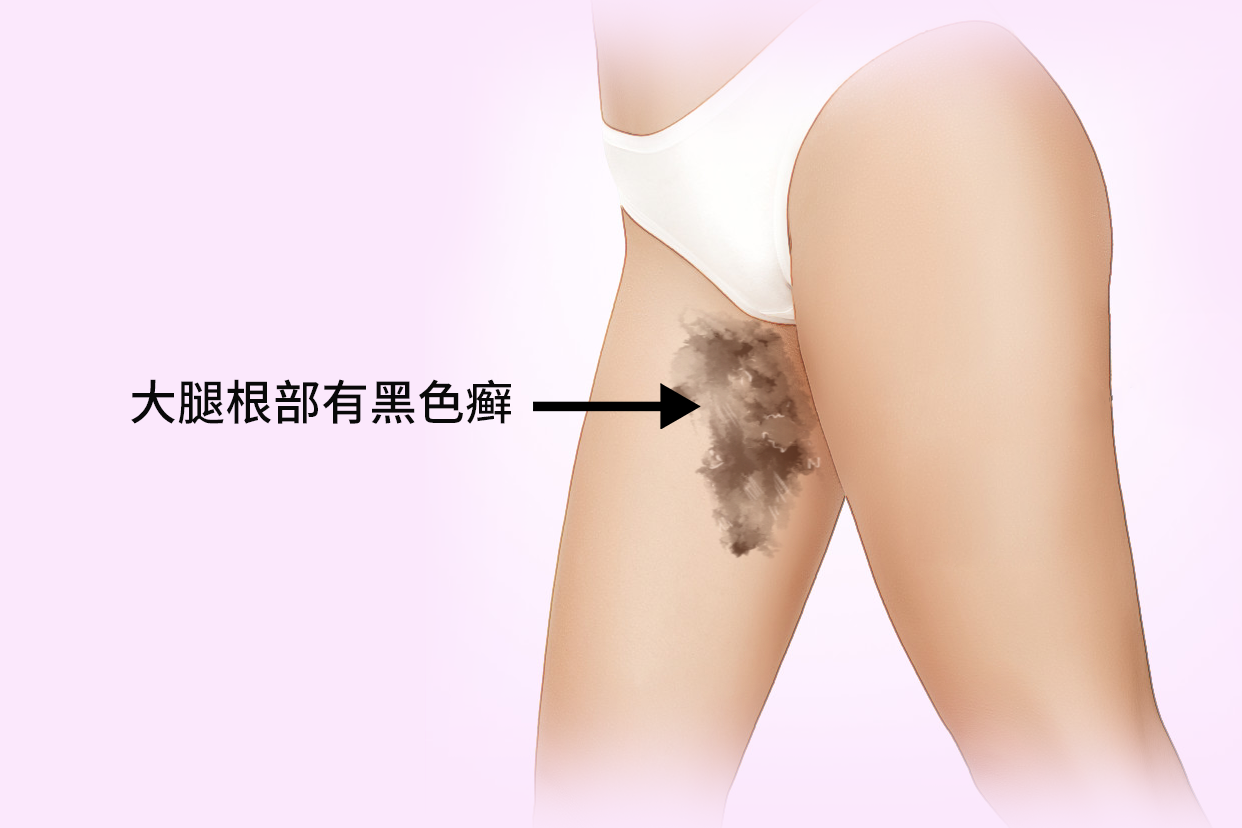 胯下、腋下紅癢怎麼辦？對磨疹保持乾爽最重要，若會痛還可用2招緩解