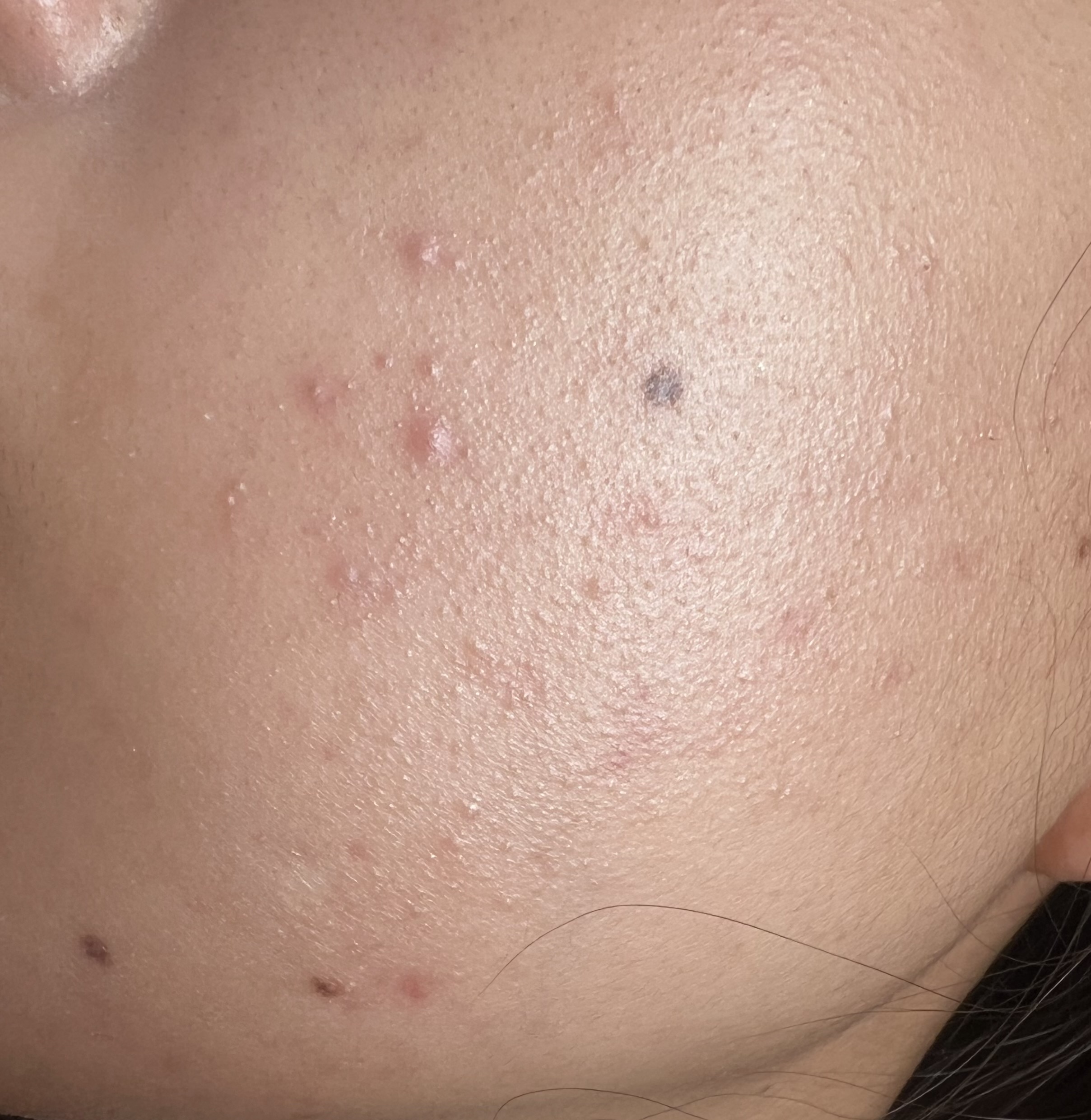 イミニ 公式サイト顔のブツブツ・ザラザラの正体は？原因・対処法も紹介