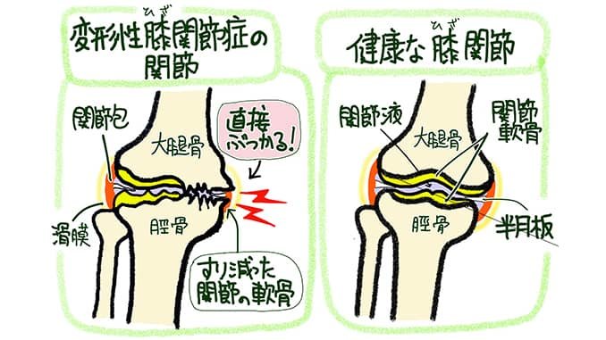 日本・世界の研究結果からみる変形性膝関節症と痛み関節とは人工関節と関節痛の情報サイト関節が痛い.com