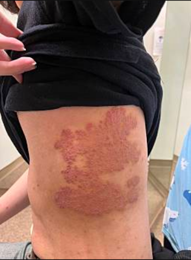 腹部の紅斑皮膚トラブルの状態チェックヒフシルワカル