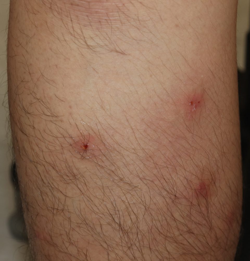 虫刺され高田馬場皮膚科・形成外科