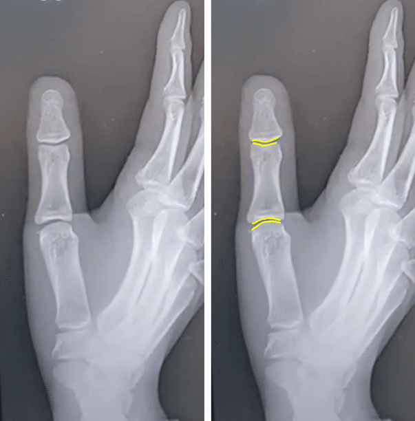 手のレントゲン写真の写真・画像素材-Snapmart スナップマート