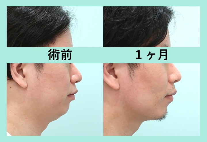 男性の頬骨縮小小木曽クリニック 美容外科・美容整形