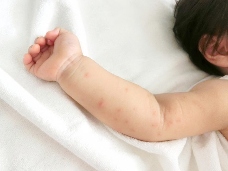 ヘルパンギーナ警報発令 十分な手洗いを インフルエンザも季節外れの流行続くTOSオンライン