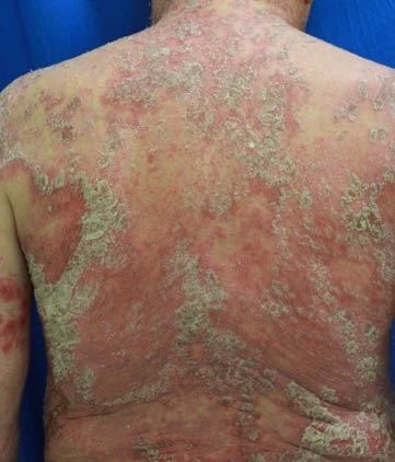 内臓からくる、かゆい湿疹とは？肝臓病や腎臓病と皮膚症状の関係を画像で解説- ヨクミテ医師監修の医療メディア