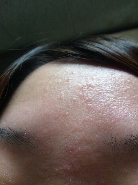 肌断食でニキビが治る肌と、肌断食も効かない肌